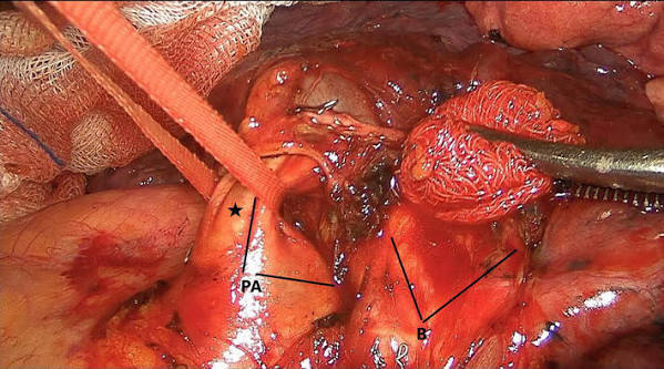 آنژیوگرافی ریوی CT: نقص پرشدگی در شریان ریوی اصلی راست.